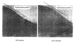 Radical therapeutic agent for keloid and hypertrophic scar