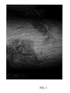 Topical medications for bruises and burns