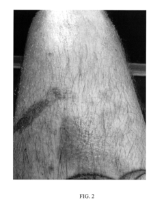 Topical medications for bruises and burns