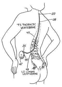 Method for treating severe tinnitus